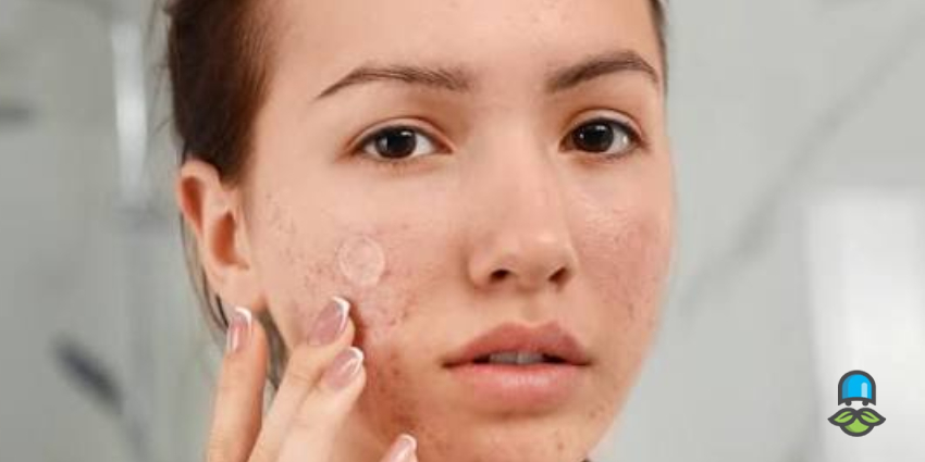 راهکارهای پیشگیری از جوش صورت